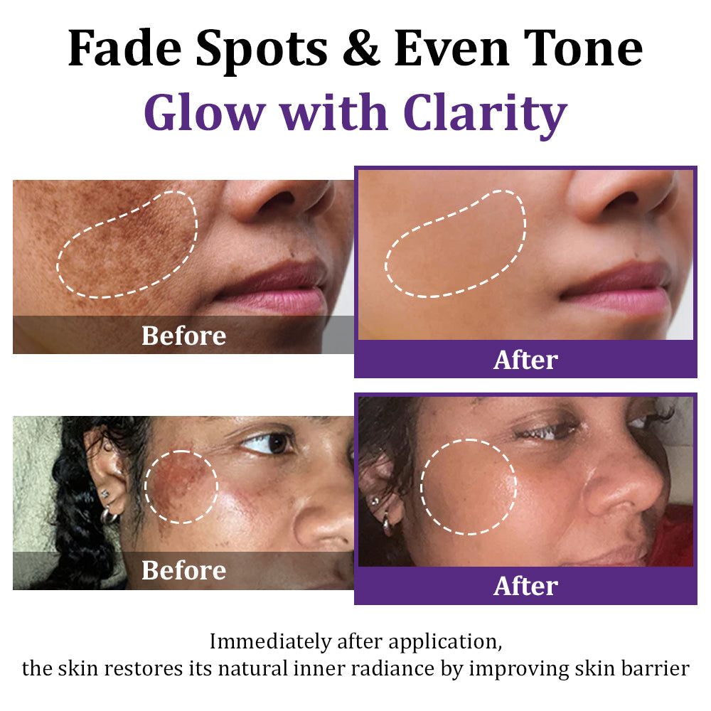 🩷✅ NHS Approved | Jorondy® EPIGLOW MelanEX Advanced Cream – clinically designed to correct face and body pigmentation, including melasma, age spots, sun spots, dark scars, acne marks, underarm darkening, and spider veins.