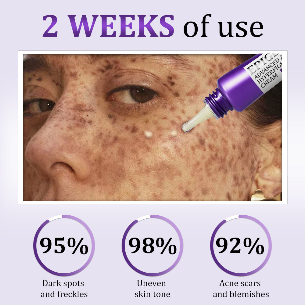 🩷✅ NHS Approved | Jorondy® EPIGLOW MelanEX Advanced Cream – clinically designed to correct face and body pigmentation, including melasma, age spots, sun spots, dark scars, acne marks, underarm darkening, and spider veins.